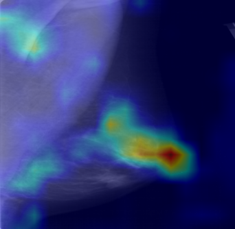 Grad-CAM heatmap overlaid on a mammogram from the CBIS-DDSM collection
